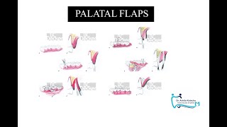 PALATAL FLAPS PARTIAL THICKNESS PALATAL FLAPS  DR ANKITA KOTECHA  DENTAL STUDIES SIMPLIFIED [upl. by Esineg531]