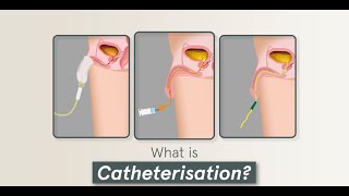 4 Minute Learning Urinary Catheterisation Male amp Care [upl. by Aleyak61]