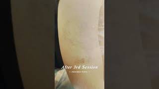 Laser Tattoo Removal Before amp After dermaworlddelhi [upl. by Hylton]