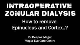 Intraoperative Zonular Dialysis How to remove Epinucleus and Cortex  Dr Deepak Megur [upl. by Sura]