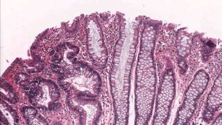 Colon tubular adenoma demonstrating low grade dysplasia  Microscopic diagnosis [upl. by Rundgren229]