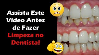 Limpeza nos Dentes Qual o Valor e Como é Feita  Dentista Responde Dúvidas Sobre Remoção de Tártaro [upl. by Annal]