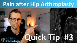 Pain after hip arthroplasty on MRI  a subtle finding MSKrad quick tip 3 SHORTS [upl. by Meredithe427]