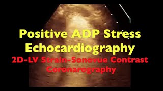 Positive ADP Stress Echo 2D LV Strain Sonovue Contrast Coronarography [upl. by Lucille285]