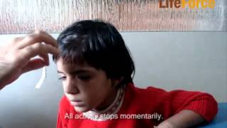 Video of Child with Petit Mal Epilepsy Attack Induced by Exertion Physical Effort [upl. by Reinaldos769]