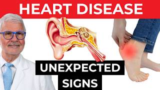 OVERLOOKED Signs Of Heart Disease DO NOT IGNORE  Dr Gundry [upl. by Harak]