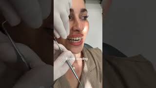 Diş aranız boşsa dolar mı dentist ciltbakımı zirkonyum [upl. by Perice]