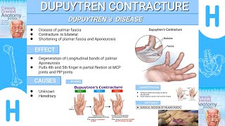 Dupuytrens ContractureFull description Dupuytrendisease [upl. by Fugere]