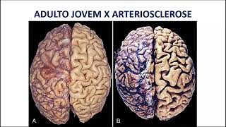 Patologia do Sistema Nervoso Central [upl. by Orravan]