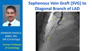 Saphenous Vein Graft SVG to Diagonal Branch of LAD [upl. by Eekcaj]