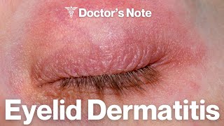 Eyelid Dermatitis Causes Treatment and Prevention  Dermatologist Explains [upl. by Dorehs]