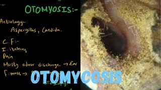 OTOMYCOSIS  Fungal Ear Infection [upl. by Nivat]