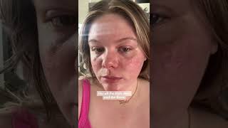 ⚡️vbeam laser for rosacea  part 1 [upl. by Mattson801]