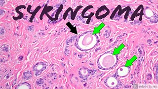 Syringoma 5Minute Pathology Pearls Tadpole  Paisley Tie Pattern Dermpath Dermatology [upl. by Lonyer]