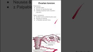 Ovarian torsion [upl. by Sirtaeb]