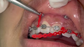 Gummy smile with orthodontic mini screws incisors intrusion with TADs with power chain placement [upl. by Yenar410]