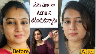 How I Cleared My Acne and Marks  My Acne Journey Clear Skin With Pictures  Treatment amp Products [upl. by Collimore806]