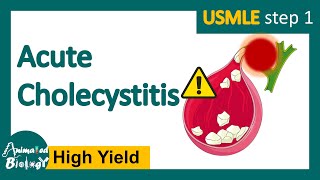 Acute cholecystitis  What is the most common treatment for cholecystitis Pathology of Acute chole [upl. by Deborah]