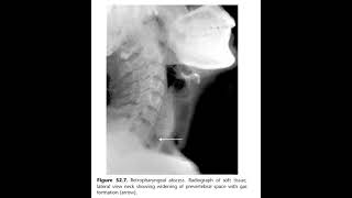 Acute retropharyngeal abscess [upl. by Nalak497]