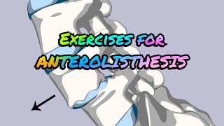 Exercises for ANTEROLISTHESIS [upl. by Peskoff]