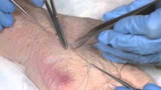 How to suture  part 3 Running mattress sutures and subcuticular sutures [upl. by Nnylrahc148]