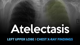 How to Interpret a Chest XRay Lesson 7  Diffuse Lung Processes [upl. by Garland289]