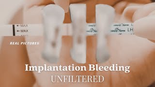 IMPLANTATION BLEEDING WITH PICTURES  Two Week Wait Bfp  Bfn Symptoms [upl. by Barnard]