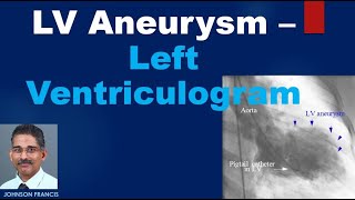 LV Aneurysm – Left Ventriculogram [upl. by Nolubez382]