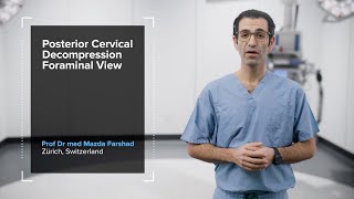 SpeedPearl Posterior Cervical Endoscopic Foraminotomy—Foraminal View [upl. by Naujyt]