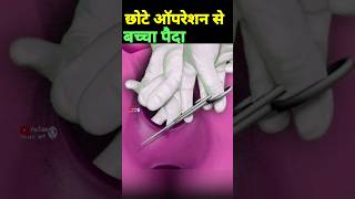 छोटे ऑपरेशन से बच्चा पैदा episiotomy delivery normaldeliverytips [upl. by Stanley]