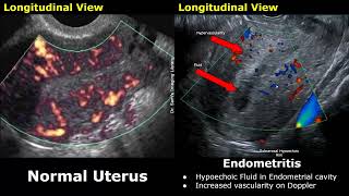 Uterus amp Adnexa Ultrasound Normal Vs Pelvic Inflammatory Disease PID Images  Gynecological USG [upl. by Acimaj]