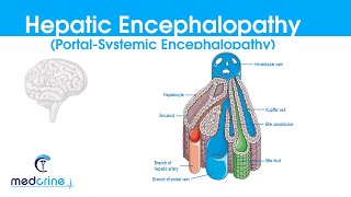 Hepatic Encephalopathy portal systemic encephalopathy causes classification featuresDX and rx [upl. by Natsreik233]