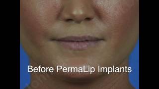 Permalip Implants [upl. by Phi822]