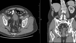 Unilateral renal seminal vesicle and Vas deferens agenesis [upl. by Arykahs]