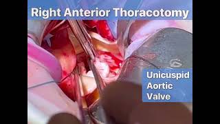 Right anterior thoracotomy AVR  Supracoronary Ao replacement [upl. by Bannerman]