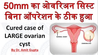 50mm Ovarian Cyst cured without surgery permanent cure of ovarian cyst Homoeopathic wonder cure [upl. by Kerrie]