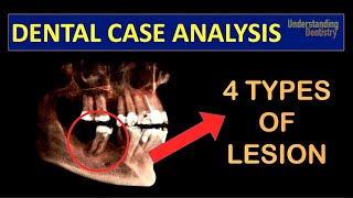 TRY TO DIAGNOSE A Case with 4 TYPES of PERIAPICAL LESIONS radicular cyst close to IAN Dental Quiz [upl. by Oht460]