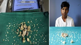 Indian Teen Ashik Gavai Has 232 Teeth Removed In 7 Hours Operation [upl. by Livvi929]