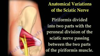 Piriformis Syndrome  sciatica  Everything You Need To Know  Dr Nabil Ebraheim [upl. by Munro701]