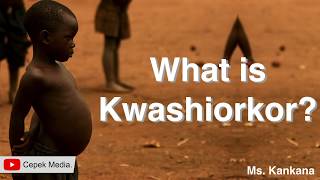 What is Kwashiorkor disease  Medical Science  General Medicine [upl. by Prince]