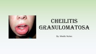 Cheilitis granulomatosa  causes signs amp symptoms investigation treatment [upl. by Llewxam]