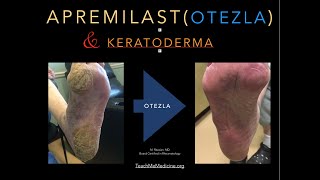 Apremilast Otezla and Keratoderma [upl. by Nealey]