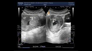 Ultrasound Video showing Incomplete abortion [upl. by Aicil939]