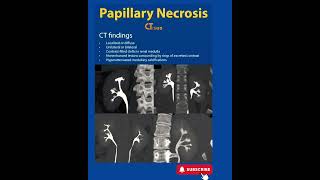 Papillary Necrosis  CT  Radiology [upl. by Rankin776]