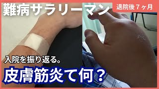 【皮膚筋炎とは】【About Dermatomyositis】退院７ヶ月患者が振り返る。A patient looks back 7 months after being discharged [upl. by Adanar68]