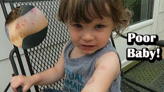 TODDLER HAS MOLLUSCUM CONTAGIOSUM TREATED [upl. by Dustie]