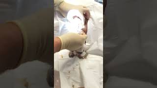 Exploding grapefruit sized sebaceous cyst popping [upl. by Graham]