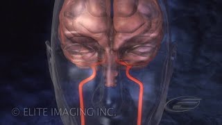 Brain Clot Removal  Medical amp Scientific Video Production [upl. by Hildie172]