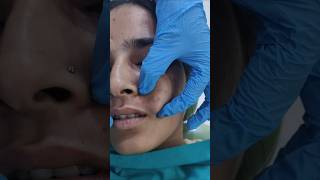 Epidermoid Cyst explore viralvideo cystpoping face surgeryrecovery omfs [upl. by Ethelstan]