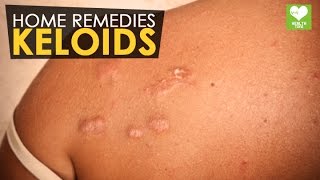 Keloids  Home Remedies  Health Tone Tips [upl. by Ydnahs255]